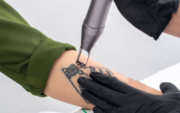 Are Laser Tattoo Removals Safe? What You Need to Know Before Erasing Your Ink