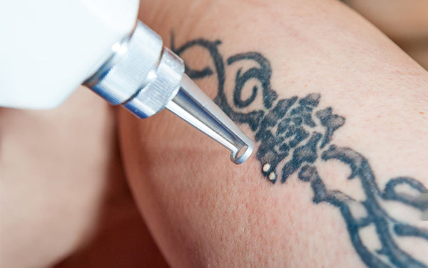 Exploring the Experience of Laser Tattoo Removal