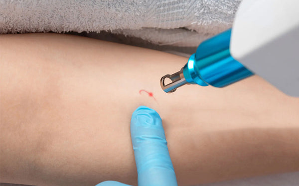 Exploring Laser Tattoo Removal: A Comprehensive Guide