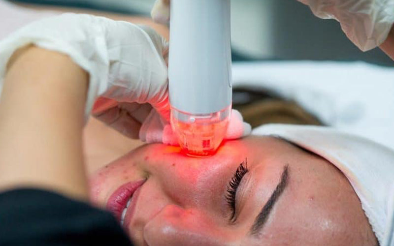 Is Fractional RF Better Than Microneedling?