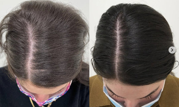 What Can 650nm Diode laser Hair Growth Machine Do?