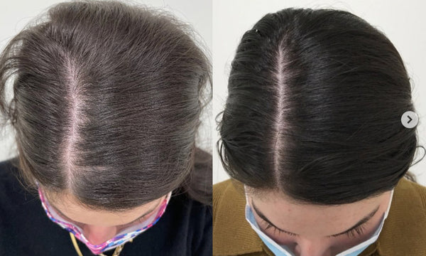 How does Diode Laser Hair Growth machine Treat  hair loss?