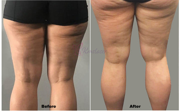 Can Pressotherapy Help with Weight Loss?