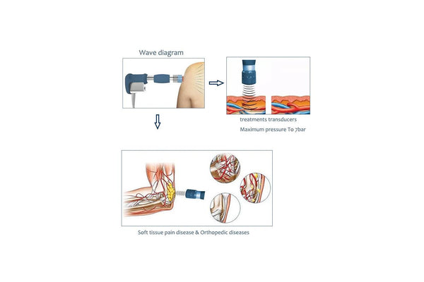 Do Home Shockwave Therapy Machines Work?
