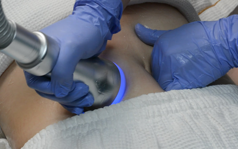 Does Cryoskin Really Work? A Comprehensive Guide to Cryotherapy for Fat Reduction and Skin Tightening