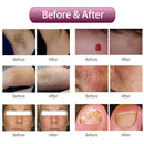 laser hair removal machine Long Pulsed Nd YAG Laser pro 1064nm Alexandrite 755nm