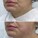 40.68HZ Vmax Thermolift Portable Cooling Vacuum RF Radio Frequency Skin Tightening Machine