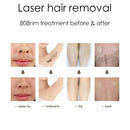 2 in 1 picosecond nd yag laser carbon peel tattoo removal device 808 diode spa equipment hair removal Beauty machine aesthetic