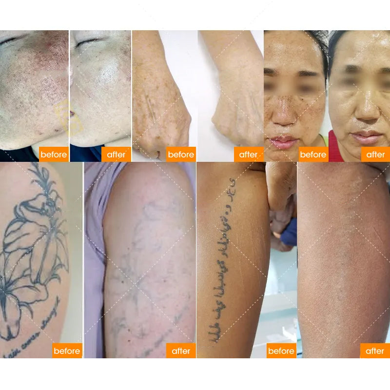Laser Picosecond Coffee Spot Removal Tattoo Remover Laser Clinic Using Q Switch Picosecond Laser