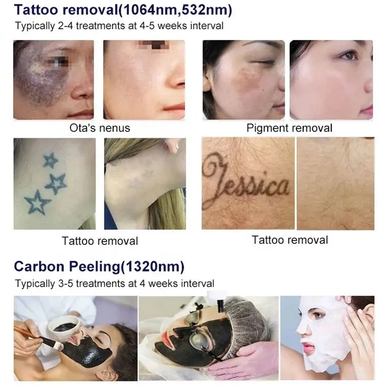 Q switch nd yag laser rejuvenation tattoo removal pigmentation removal laser machine