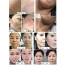 6 In 1 Hifu Machine Hifu Vaginal Tightening Eye/Neck/Face Lift Korea Body Slimming Fat Removal Machine RF Microneedling