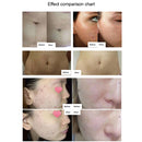 6 In 1 Hifu Machine Hifu Vaginal Tightening Eye/Neck/Face Lift Korea Body Slimming Fat Removal Machine RF Microneedling