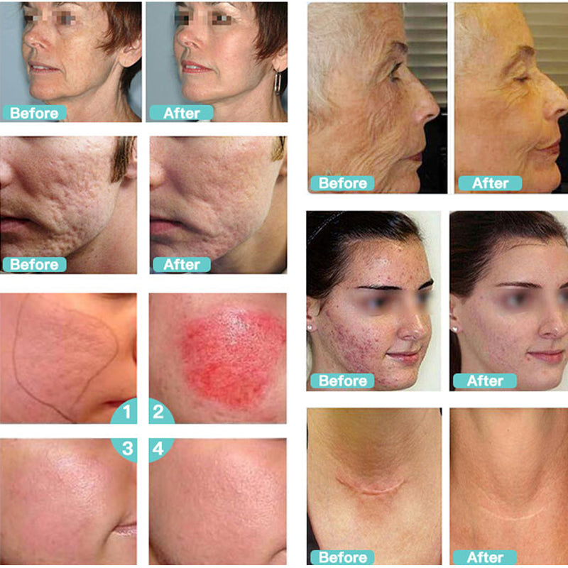 Skin Rejuvenation Wrinkle Removal Skin Tightening Rf Beauty Machine Rf Fractional Microneedle Acne Removal Skin Care