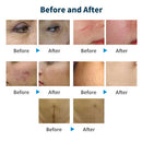 CO2 Fractional Laser Machine Skin Tightening Resurfacing Smooth Scars Acne