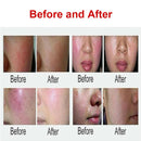 980 spider removal vascular vascular lesions removal diode laser remove leg vein