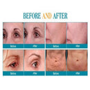 RF Wrinkle Removal Machine with Cold Hammer Micro Needle RF Acne Removal