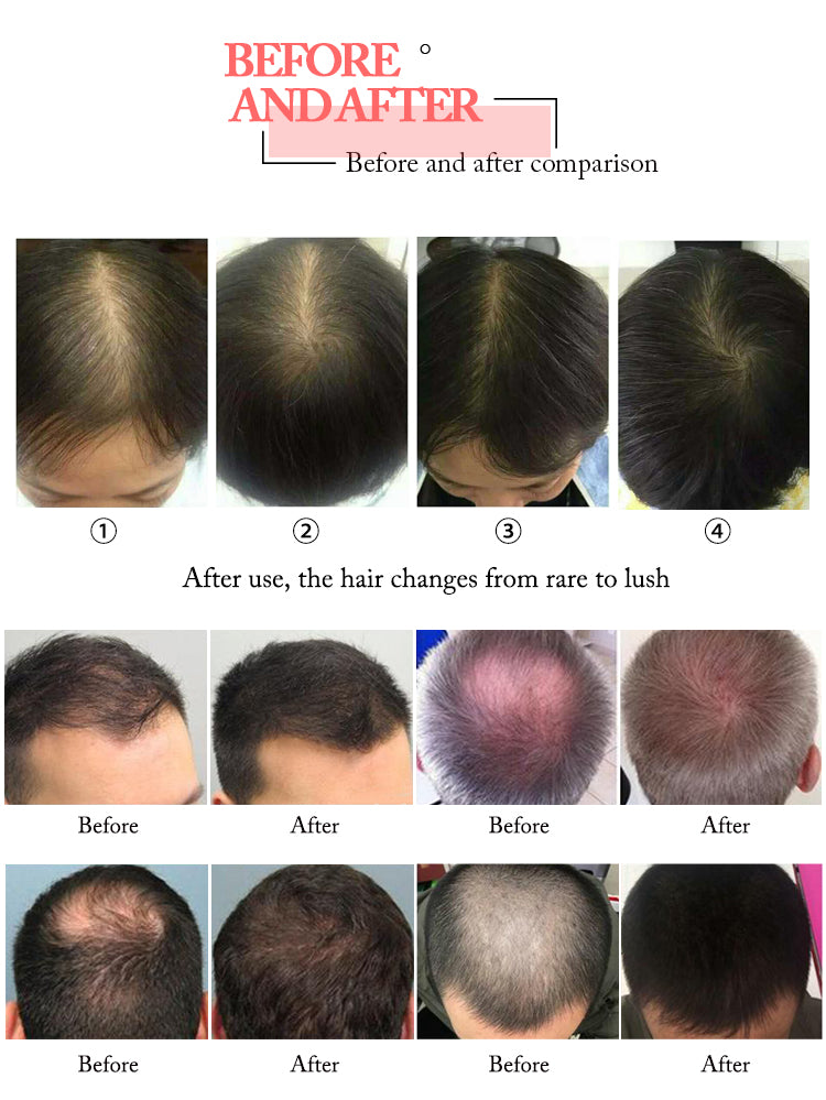Diode laser hair loss treatment hair regeneration laser hair growth machine